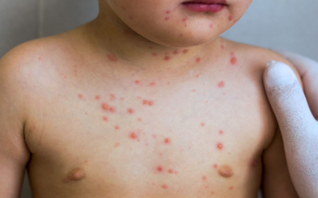 Varicella/chickenpox in kids