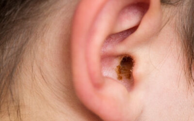 Managing Ear Wax in Children: A Guide for Parents and Carers